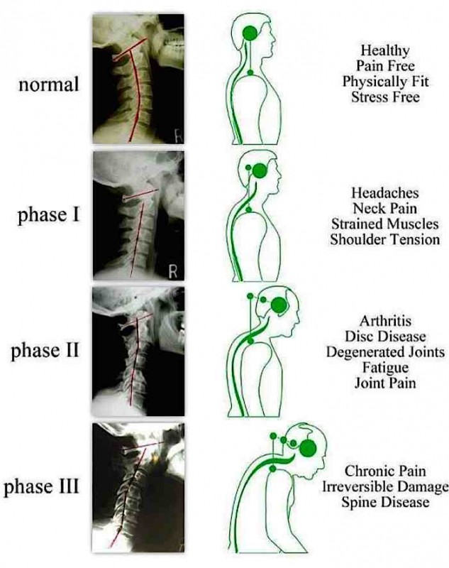 Forward Head Posture: Articles & Research